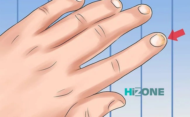 دست ناخن های آلوده با قارچ یا باکتری