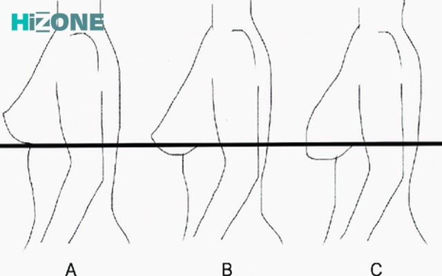 نمودار افتادگی سینه‌ی زنان