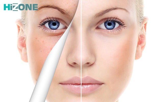 صورت یک زن با نمای شماتیک از حذف لکه های پوستی بعد از پیلینگ شیمیایی پوست